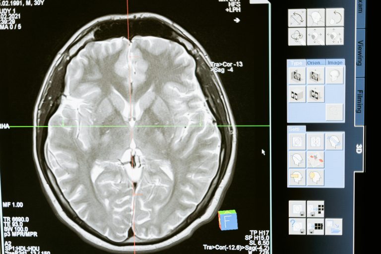 Alzheimer ontstaat mogelijk buiten de hersenen: nieuw onderzoek biedt hoop op behandeling